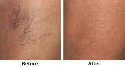 Before and after sclerotherapy spider vein treatment