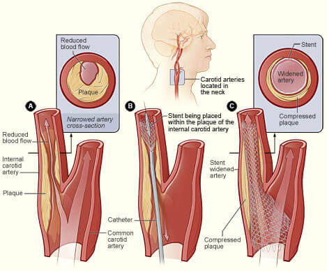 carotid stent